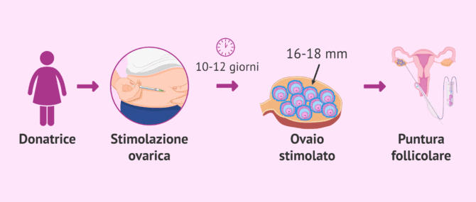 Imagen: Processo di stimolazione ovarica per la donatrice