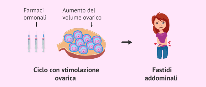 Imagen: Fastidi dovuti alla stimolazione ovarica