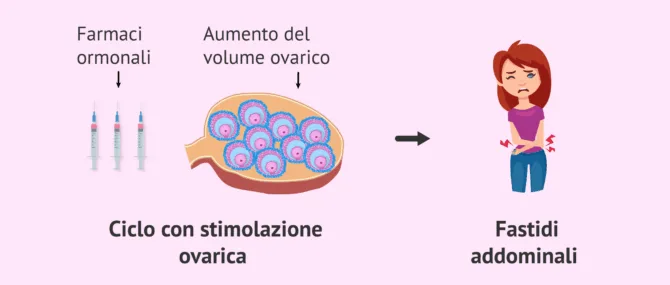 Imagen: Fastidi dovuti alla stimolazione ovarica