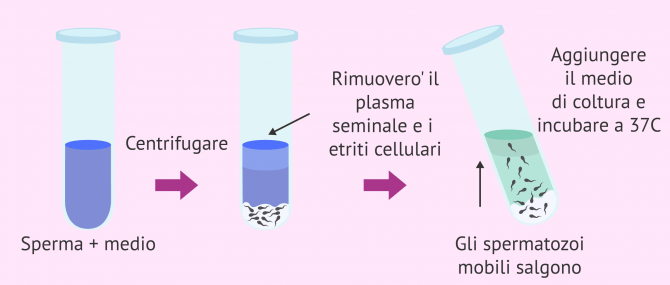 Imagen: Capacitazione via 'swim-up'