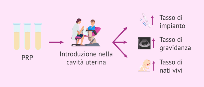 Imagen: Il plasma ricco di piastrine è efficace nella riproduzione assistita?