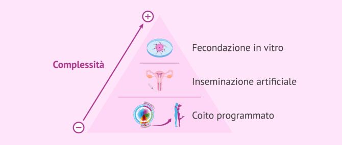 Imagen: Tecniche di riproduzione assistita dalla minore alla maggiore complessità
