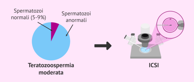 Imagen: Teratozoospermia moderata e gravidanza