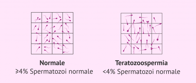 Imagen: Infertilità maschile dovuta a teratozoospermia