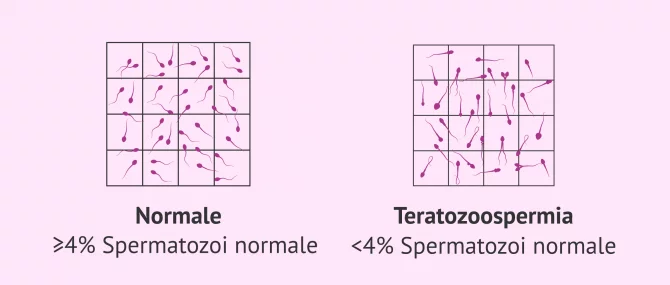 Imagen: Infertilità maschile dovuta a teratozoospermia
