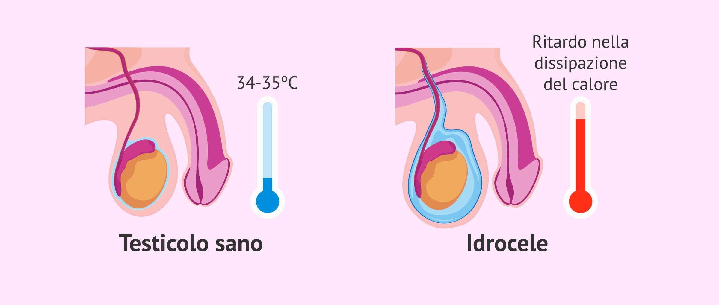 Mito medico: l'idrocele influisce o no sulla fertilità maschile?