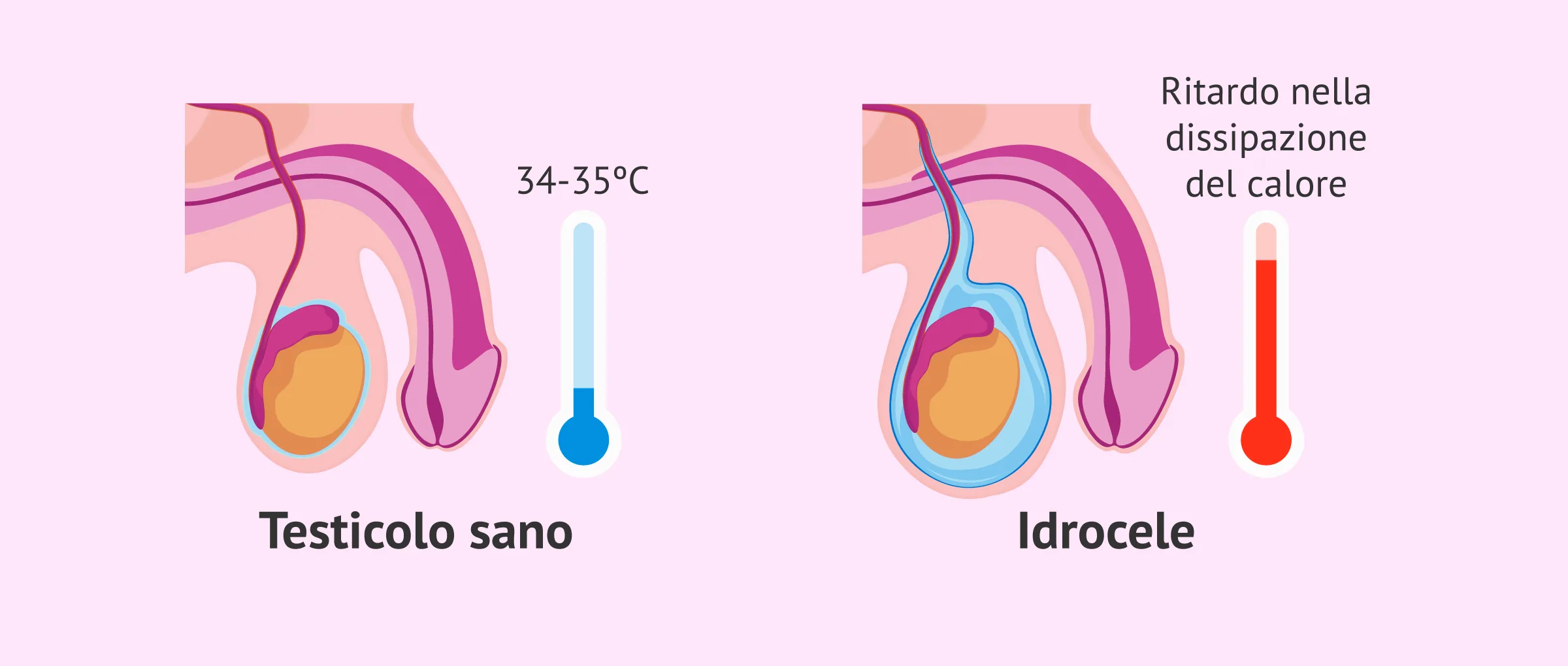Mito medico: l'idrocele influisce o no sulla fertilità maschile?
