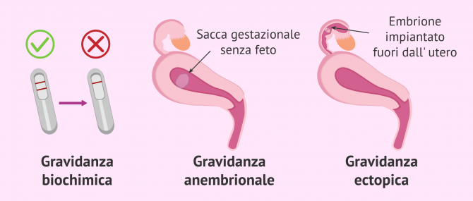 Imagen: Tipi di aborto del primo trimestre