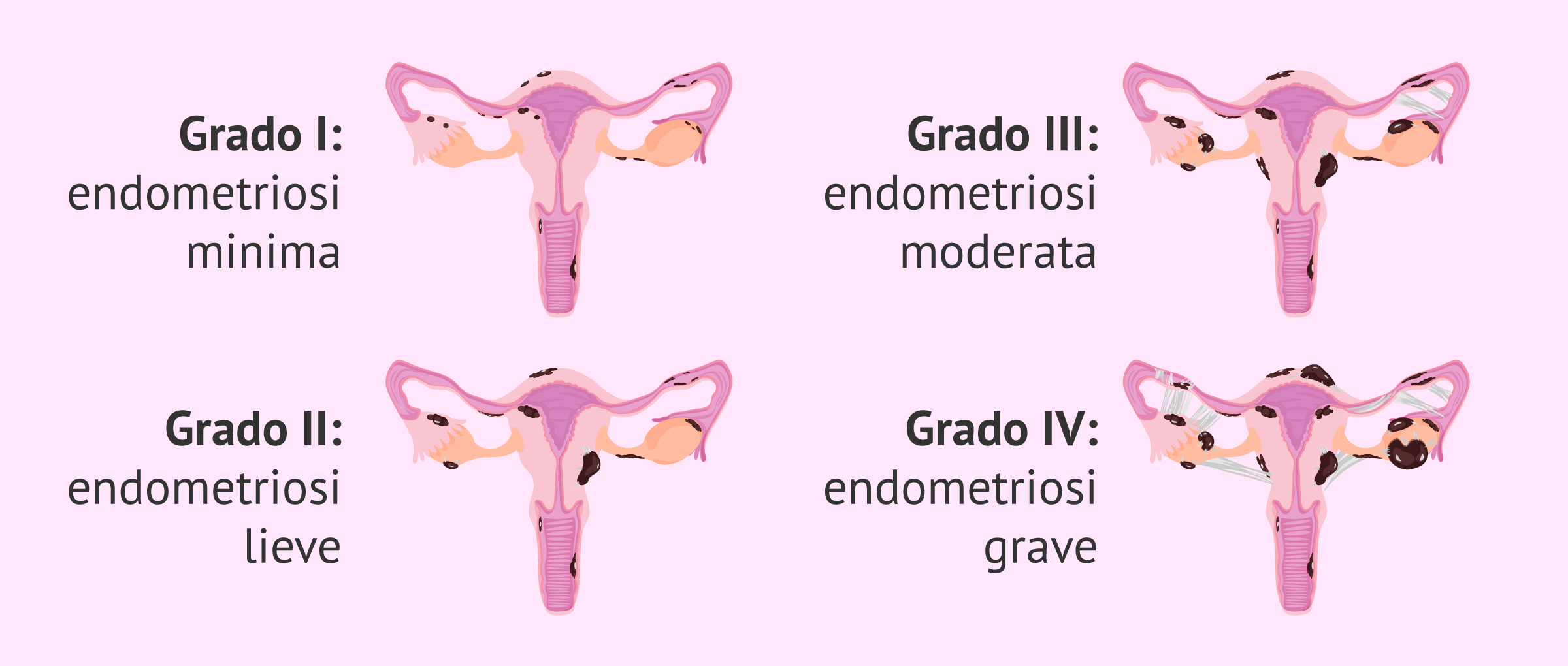 Quali sono i gradi dell'endometriosi?