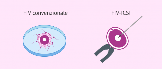 Imagen: Problemi di IVF