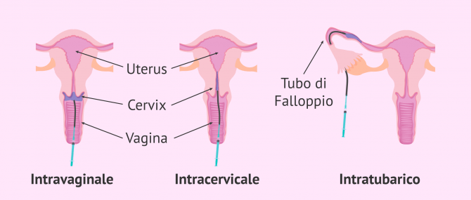Imagen: Tipi di IA a seconda di dove viene depositato lo sperma