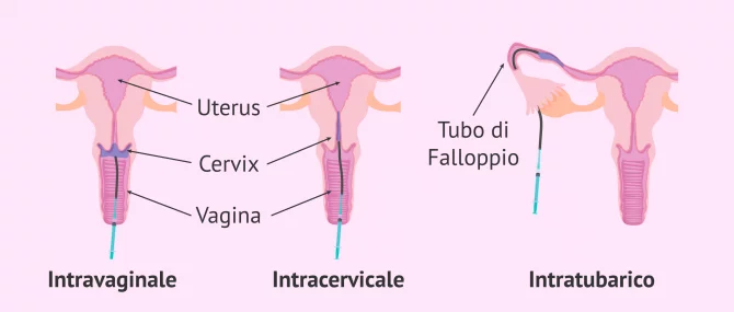 Imagen: Tipi di IA a seconda di dove viene depositato lo sperma