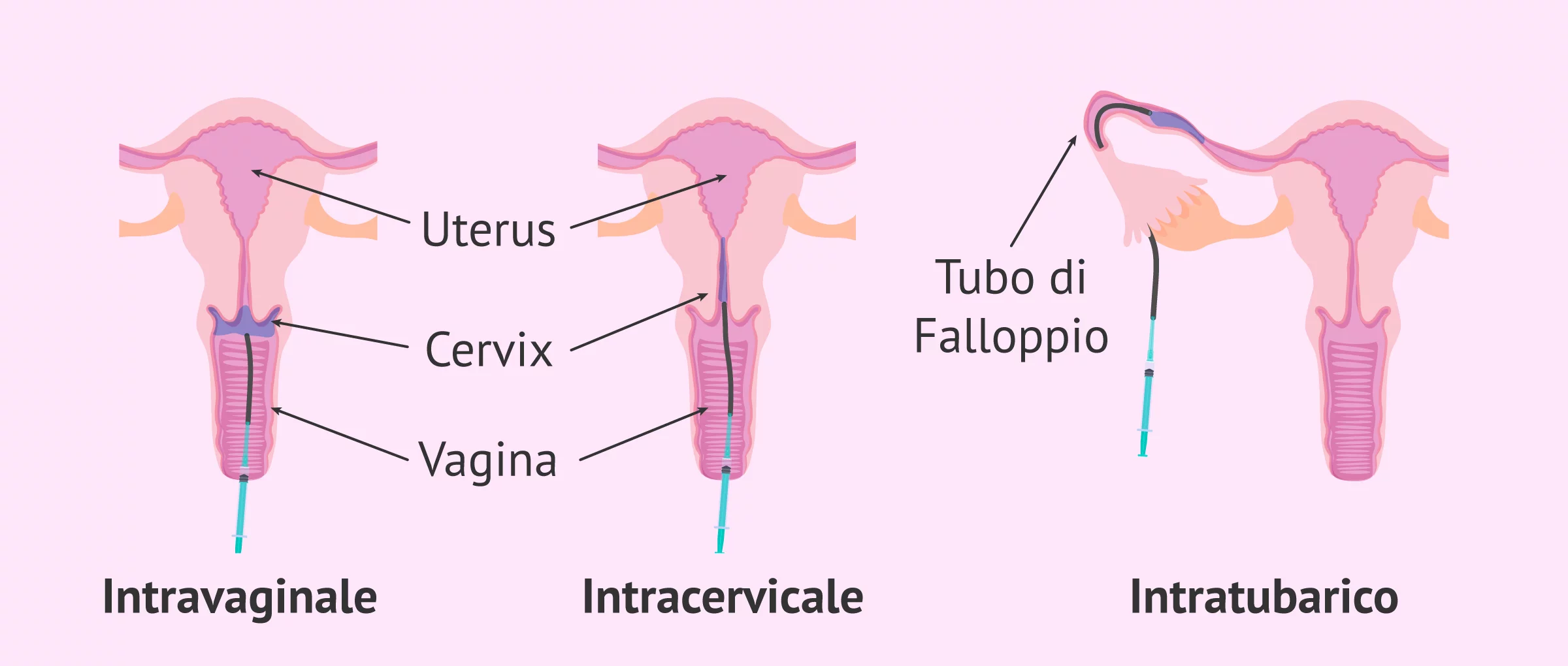 Processo di inseminazione artificiale