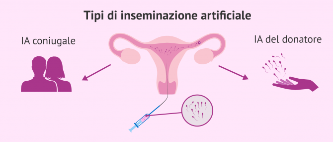 Imagen: Inseminazione intrauterina nella IA
