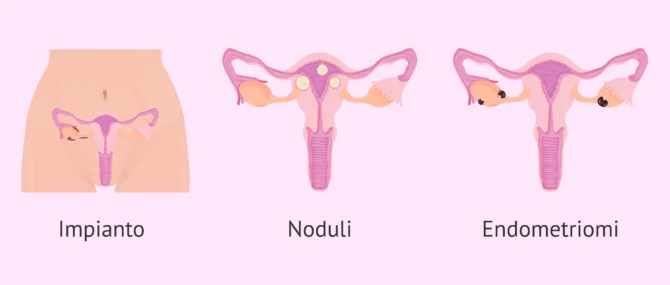 Imagen: Placche endometriali secondo la gravità