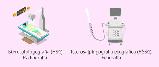 Imagen: Tipi di isterosalpingografia o HSG
