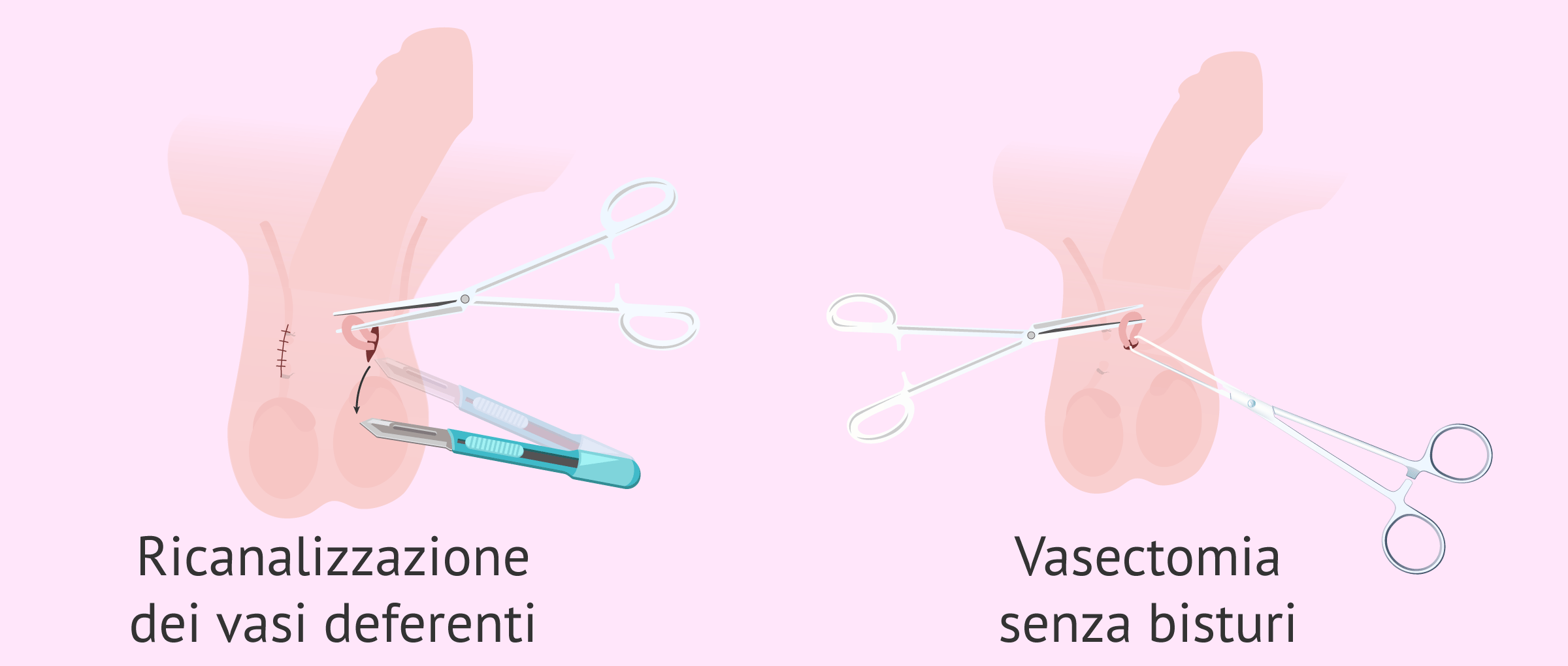 Tipi di chirurgia della vasectomia