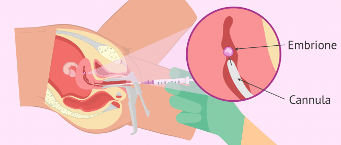 Imagen: Trasferimento di embrione