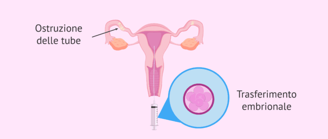 Imagen: FIVET con ostruzione tubarica
