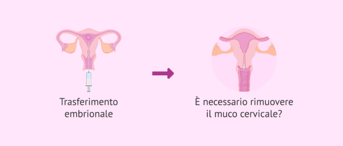Imagen: Rimuovere o meno il muco cervicale prima del trasferimento embrionale