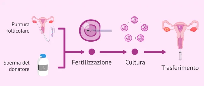 Imagen: Processo di FIVET con sperma di donatore
