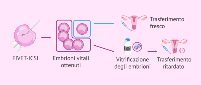 Imagen: Risultati perinatali dopo il trasferimento a fresco o differito