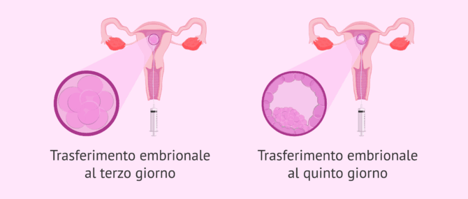 Imagen: In quale giorno si esegue il transfert embrionale?