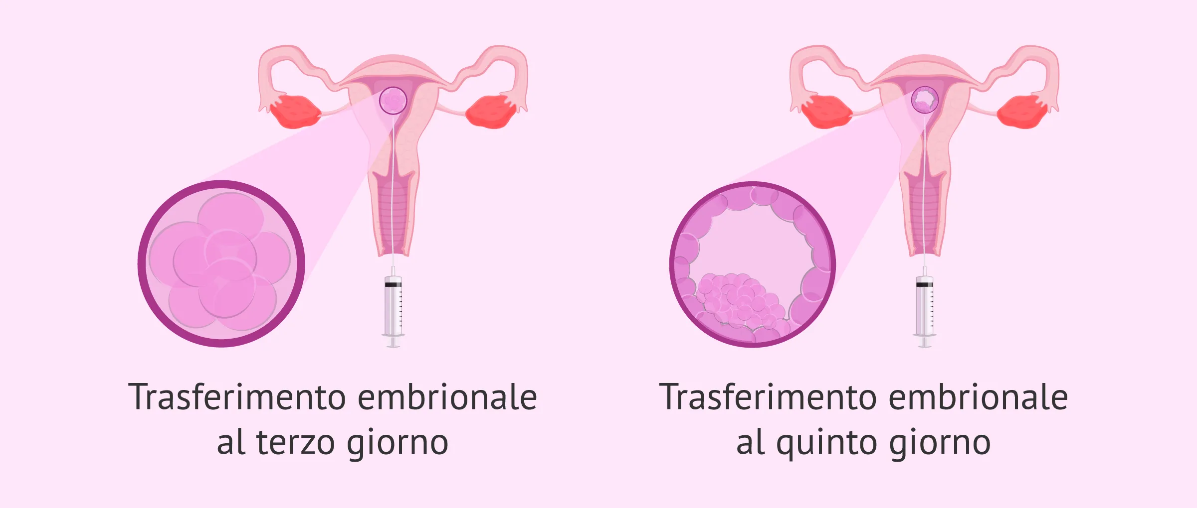 In quale giorno si esegue il transfert embrionale?