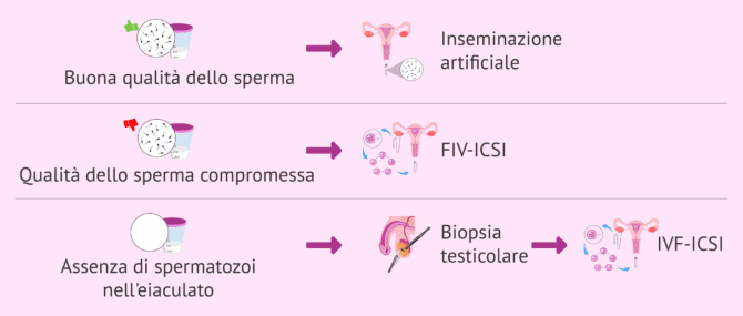 Imagen: Trattamenti per la fertilità in uomini con problemi spermatici