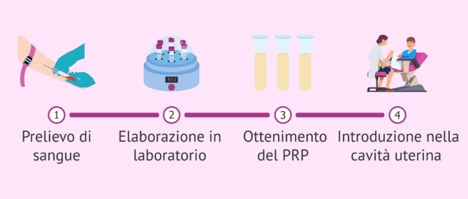 Imagen: Plasma ricco di piastrine per migliorare le possibilità di gravidanza
