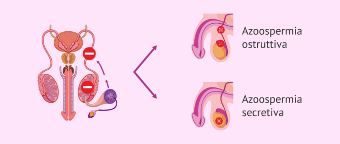 Imagen: Tipi di azoospermia: ostruttiva e secretoria