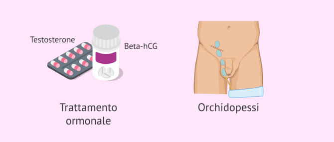 Imagen: Possibili trattamenti per il criptorchidismo