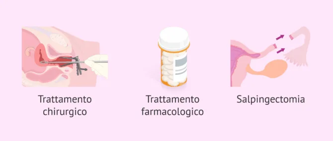 Imagen: Modi per trattare una gravidanza ectopica