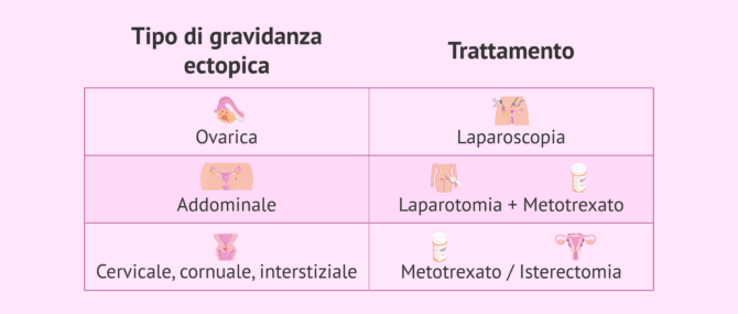 Imagen: Trattamento in base al tipo di gravidanza ectopica