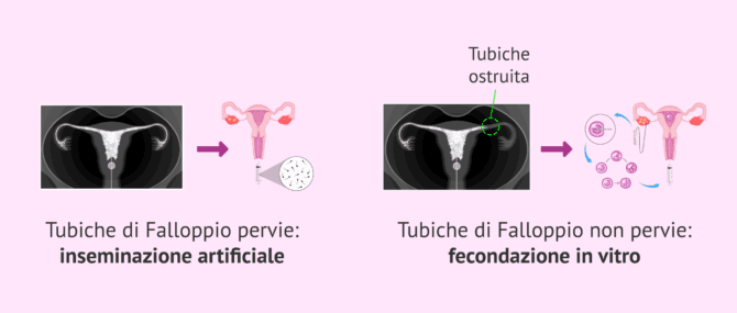 Imagen: Trattamento di fertilità in base al risultato dell'HSG