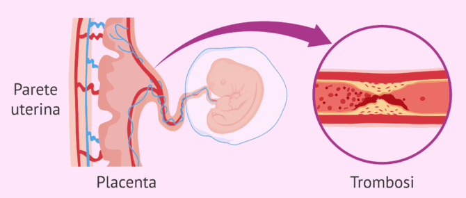 Imagen: Sindrome da anticorpi antifosfolipidi e aborti