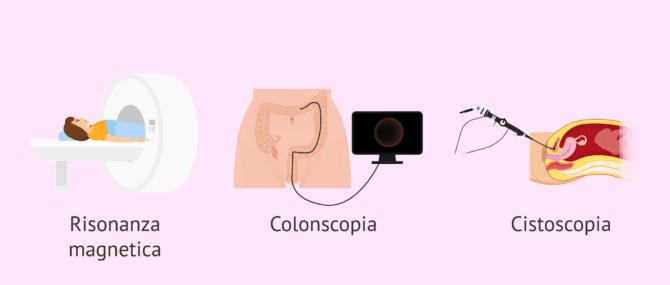 Imagen: Test complementari per diagnosticare l'endometriosi