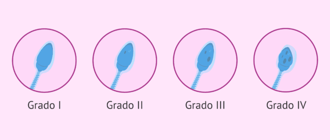 Imagen: Classificazione degli spermatozoi con vacuoli