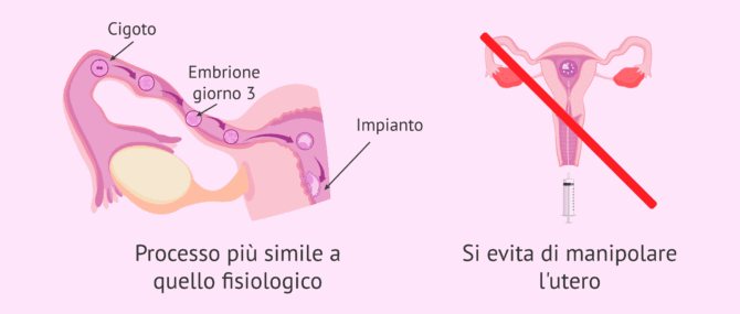 Imagen: Vantaggi del trasferimento intratubarico di zigoti