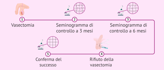 Imagen: Rifare la vasectomia in caso di insuccesso